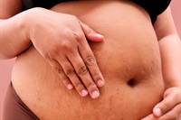 GLP-1 exposure in pregnancy does not clearly raise major birth defect risk