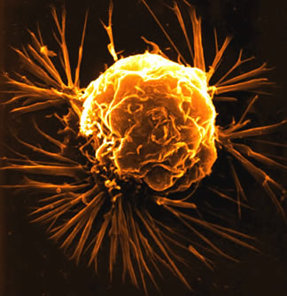 Electron micrograph of a single breast cancer cell.