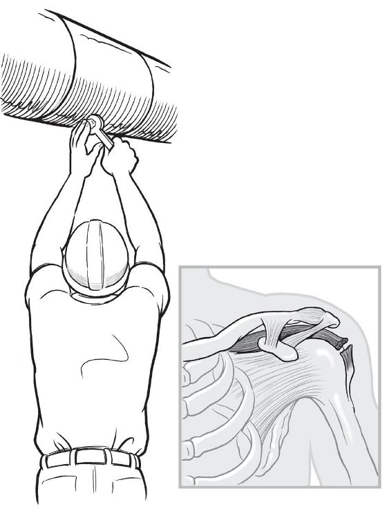The rotator cuff is a group of four muscles and their tendons that wrap around the front, back, and top of the shoulder joint. These let the shoulder function through a wide range of motions. Stress on the shoulder may cause them to tear, which can make routine activities difficult and painful.