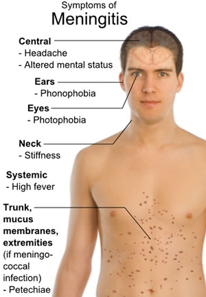 forvrængning New Zealand Uddybe Meningitis Symptoms