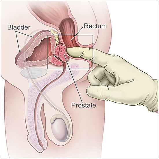 difference between prostate cancer and rectal