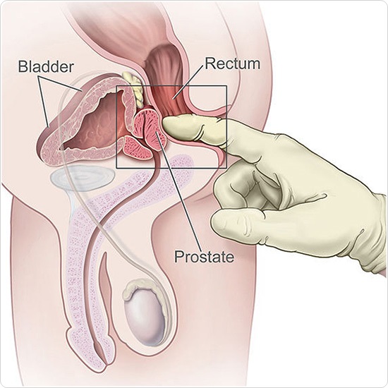 link between prostate and colon cancer