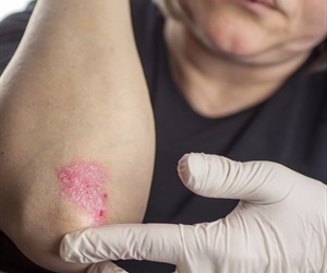 Psoriasis treatment associated with reduction in coronary artery disease