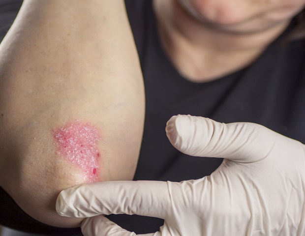 evidence based treatment for psoriasis