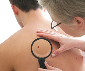 Study: States with lower incidence of melanoma have higher mortality rates