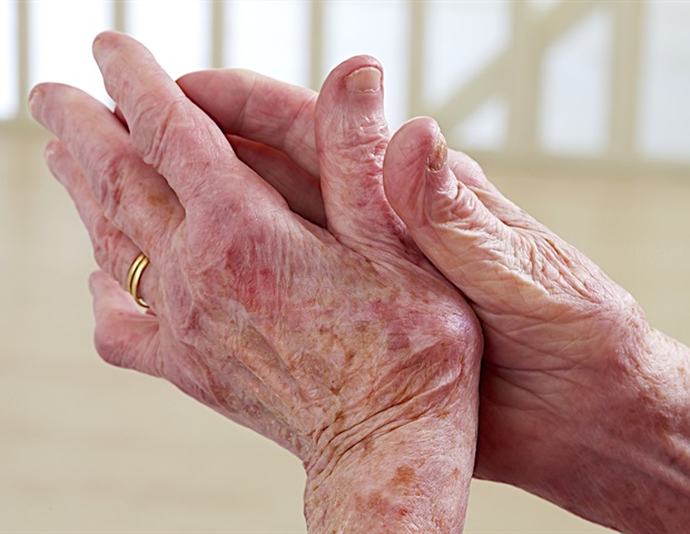 Psoriasis onset determines whether arthritis or psoriasis starts first in people with psoriatic arthritis