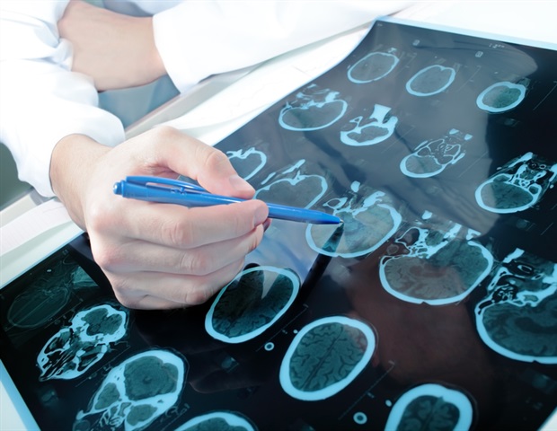 Investigational drug for treating patients with treatment-resistant epilepsy