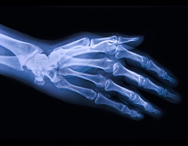 New experimental growth factor drug appears to prevent worsening of osteoarthritis