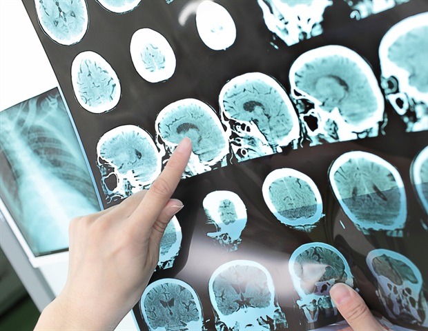 Asia-Pacific’s eminent minds to showcase latest breakthroughs in stroke research