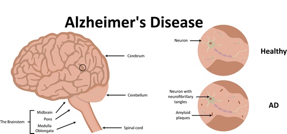 Alzheimer's tangles and plaques: what's the difference?