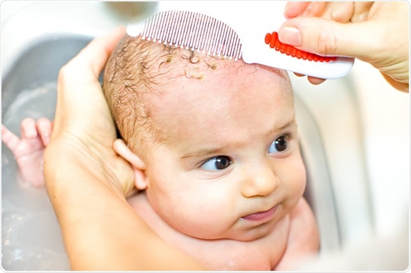 Cradle Cap Seborrheic Dermatitis In Newborns