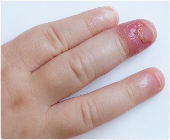 Redness of the nail bed caused by infection - wide 8