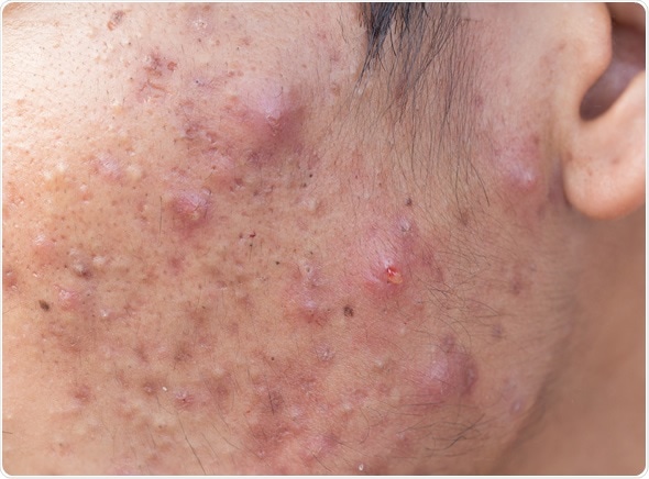 Adult Acne - Skin Disorders