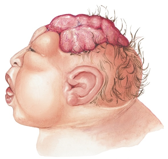 Anencephaly meaning