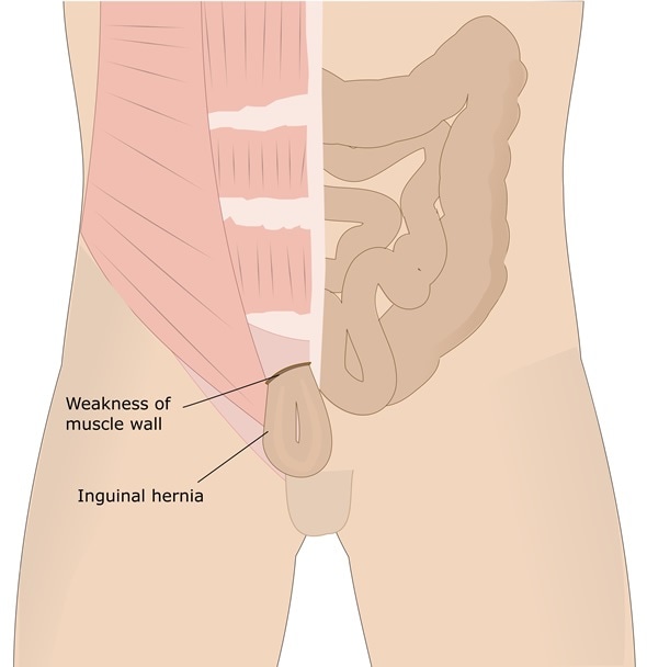 Hernia Inguinal Sintomas Y Causas Mayo Clinic