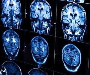 Study provides new understanding of how the brain recovers from damage caused by stroke