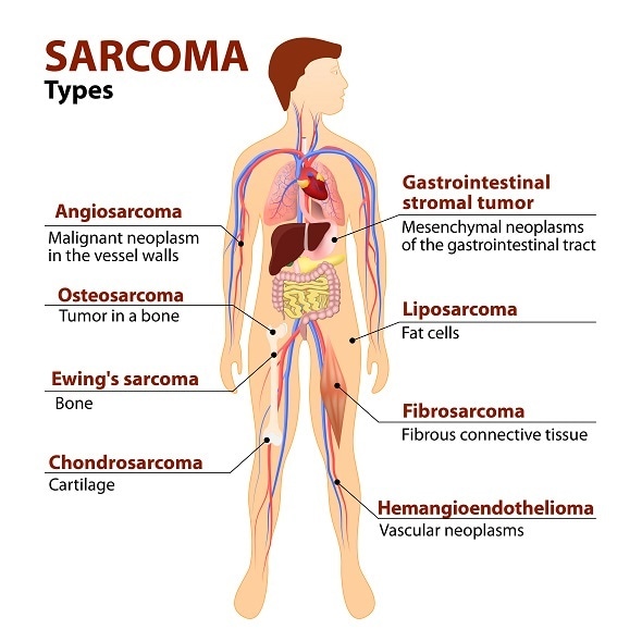 sarcoma cancer centers history of human papillomavirus infection icd 10