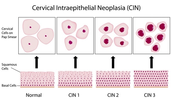 Hpv negatif et dysplasie