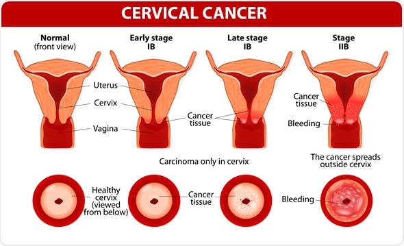 papilomavirus cervical