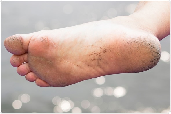 Image result for women feet cracked