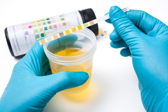 Image result for urine test