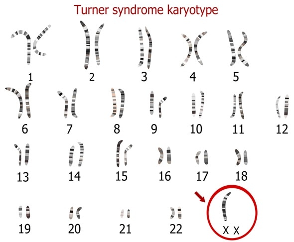 Image result for turner syndrome chromosome