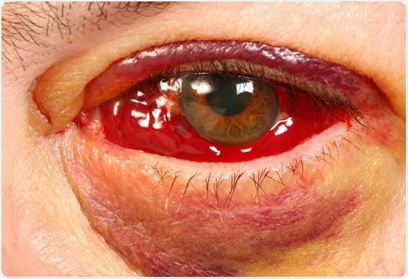 Vitreous Detachment