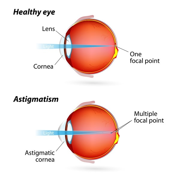 myopia hyperopia asztigmatizmus az)