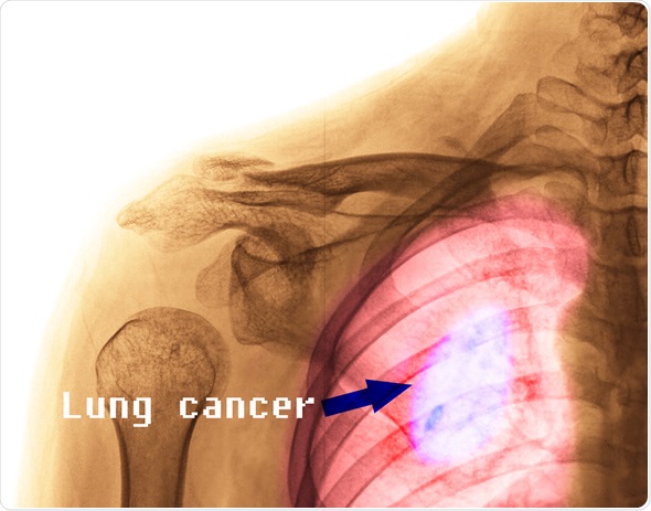 Lung Cancer Lung Cancer