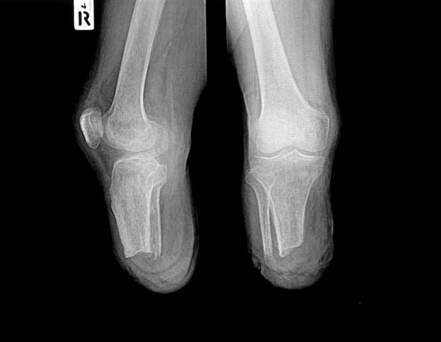 Assessing blood flow is key to early detection, treatment for patients with critical limb ischemia