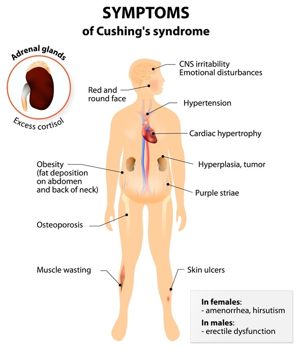 Signs and symptoms of Cushing's syndrome. Image Copyright: Designua / Shutterstock