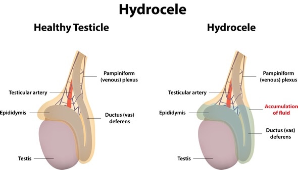 Hydrocele in Adults