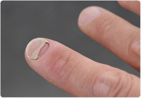 Onycholysis Detachment Of Nail 