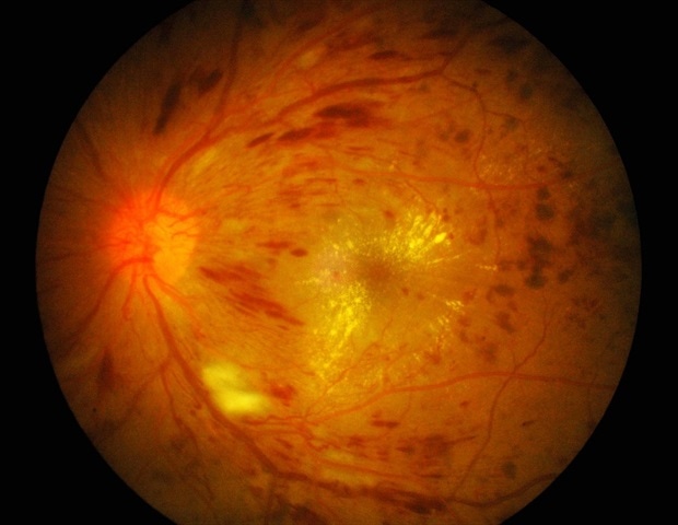 diabetic retinopathy cukorbetegség őrült