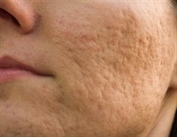 Cysts And Scarring