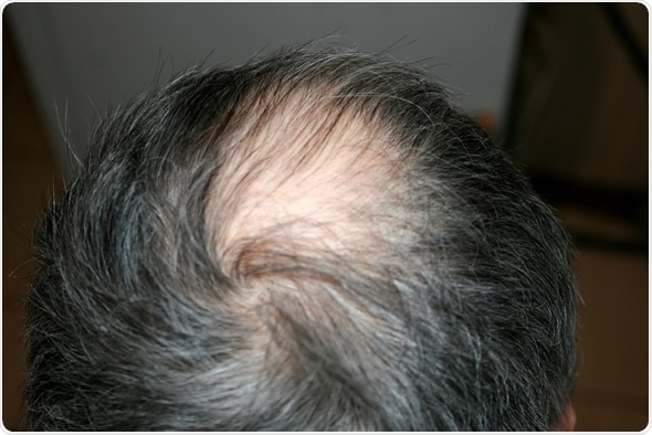 what medications can cause hair loss
