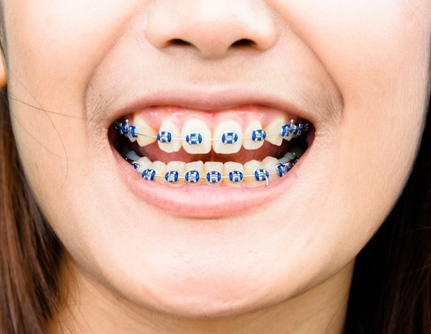 Orthodontics In Reston