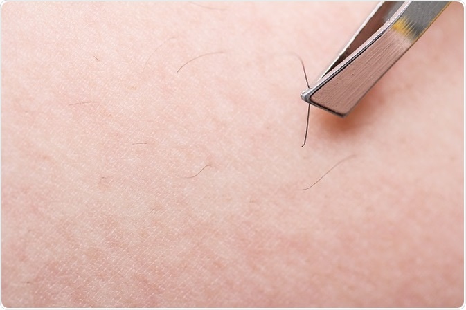 Can You Pop An Ingrown Hair With A Needle Preventing Ingrown Hairs