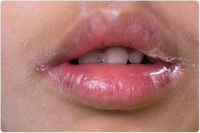 Cheilitis causes treatments