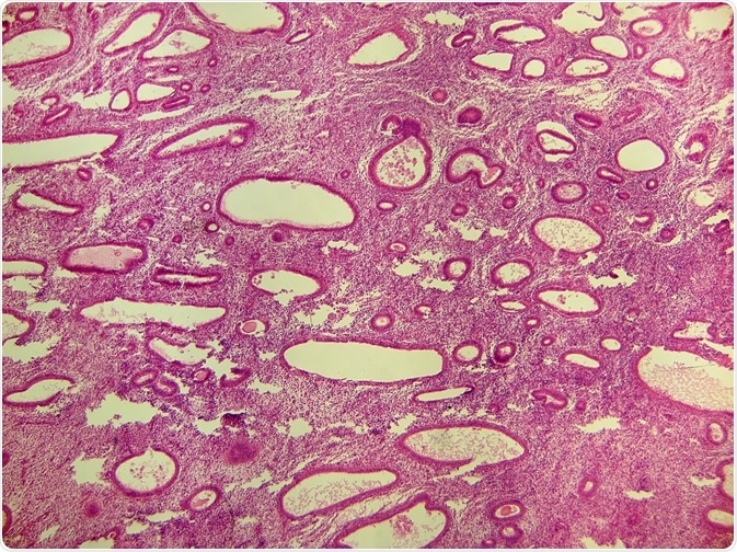 endometrium rák tumor markerek