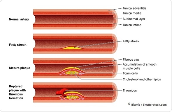 Resultado de imagem para Doença Arterial Coronariana