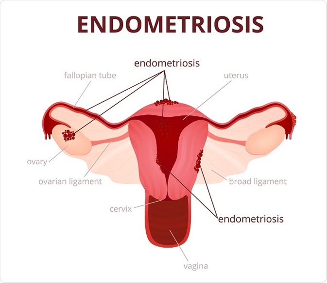 What is Endometriosis?