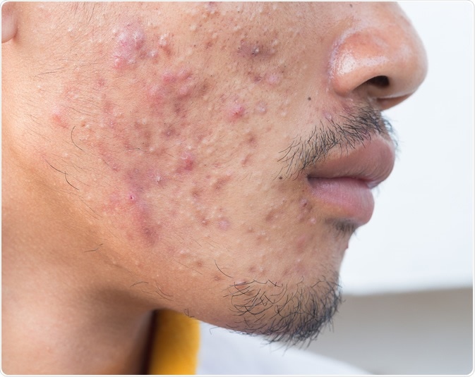 Acne in Men