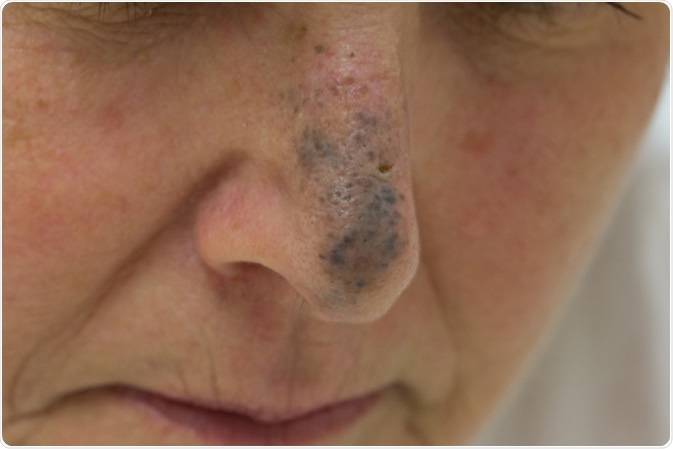 Blue nevus - Symptoms and causes - wide 3