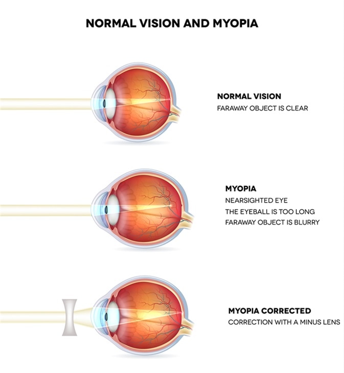 Nearsightedness And Farsightedness
