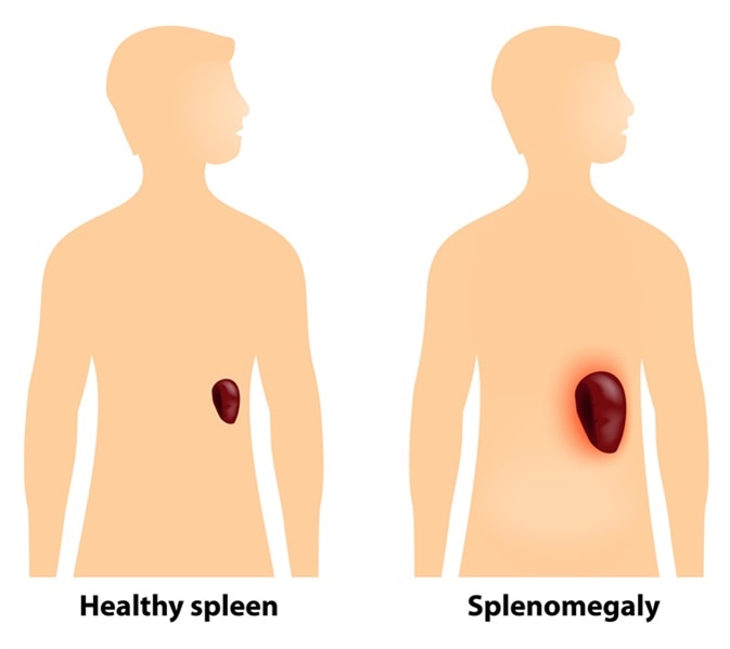 how does malaria cause enlarged spleen