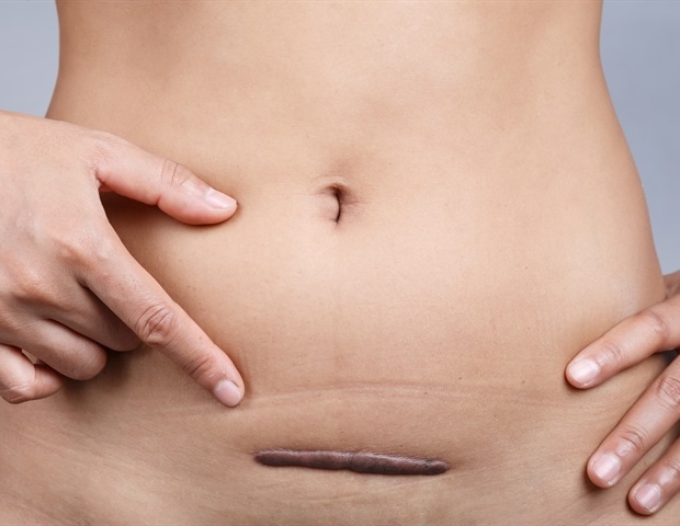 What Are Uterine Fibroids