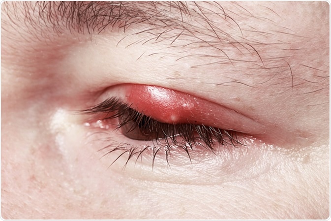 Blepharitis Types and Causes