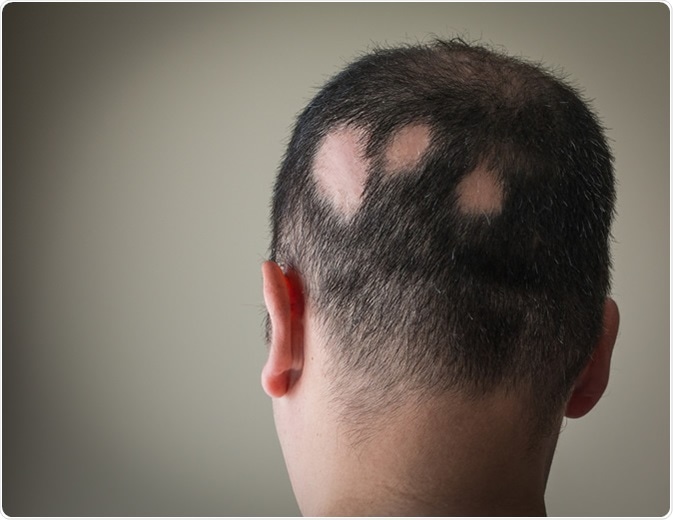 Alopecia meaning