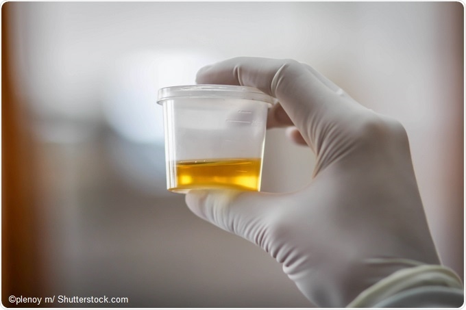 urine test for prostate cancer screening)
